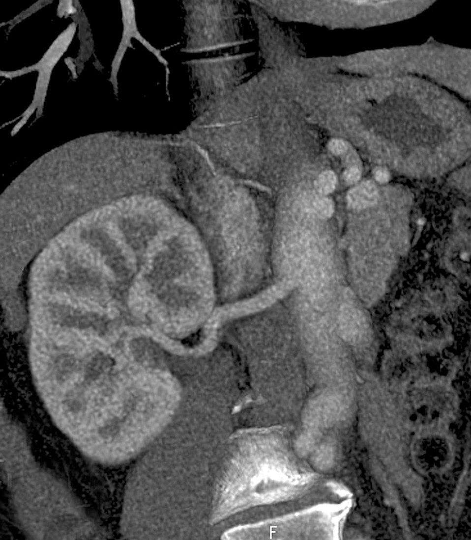 Kidney in Marfan syndrome,CT scan