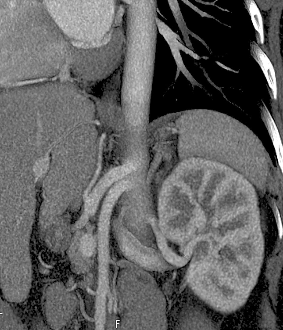 Kidney in Marfan syndrome,CT scan