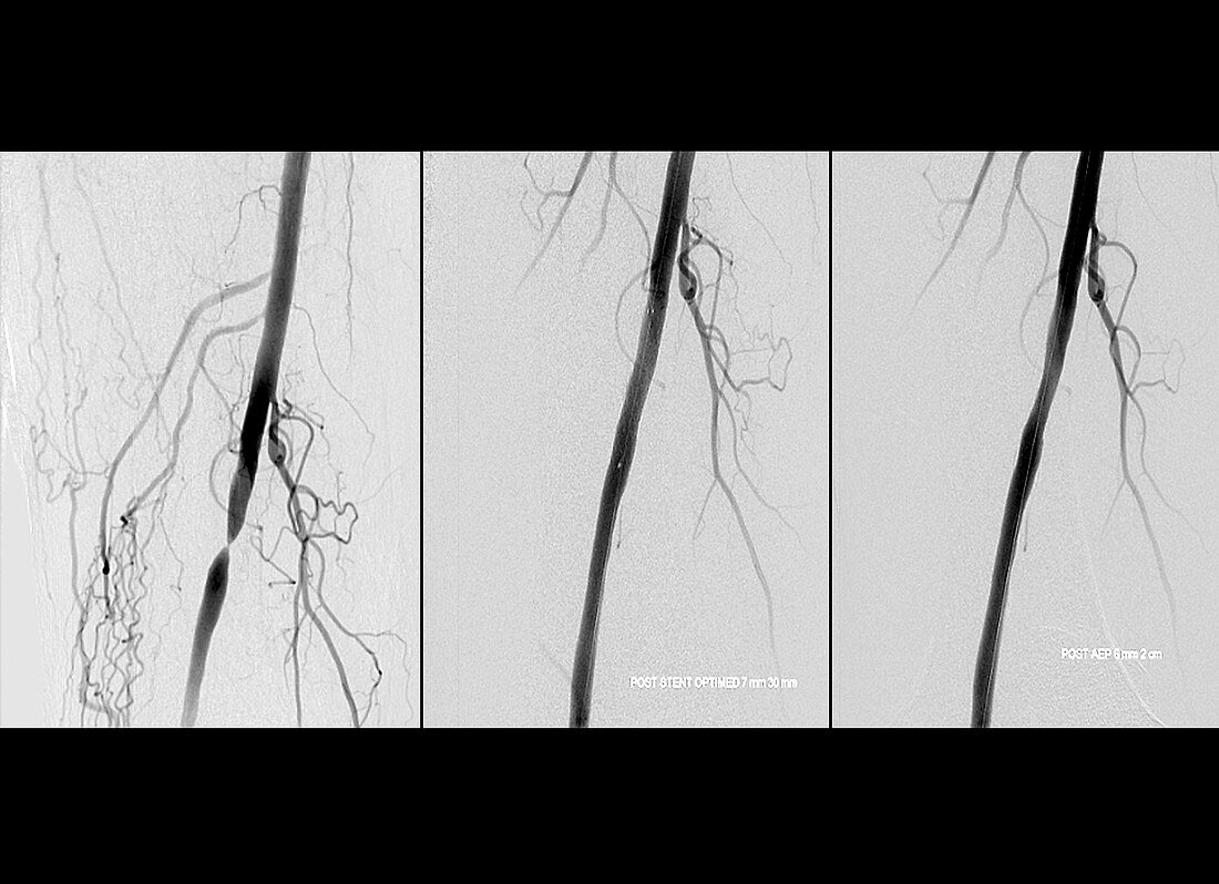 Treating nearly blocked femoral artery,angiograms