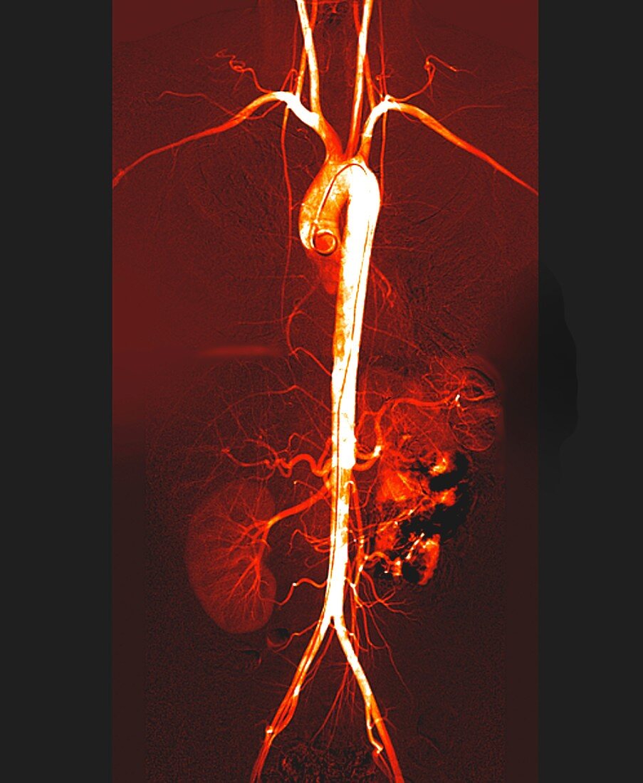 Torso arteries,digital angiogram
