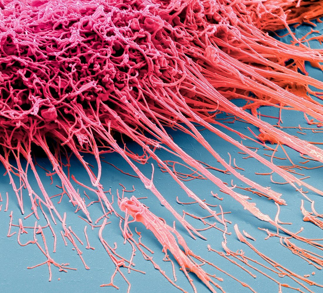 Mouth cancer cell,SEM