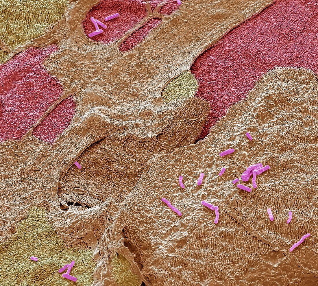 Urinary tract infection,SEM