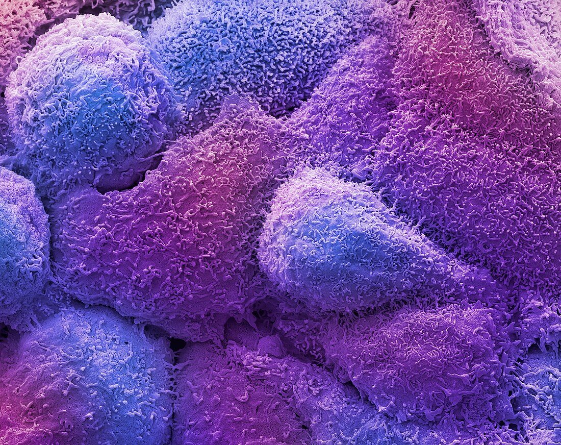 Breast cancer cells,SEM