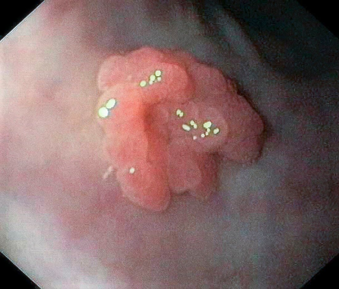 Oesophageal papilloma,endoscopy image
