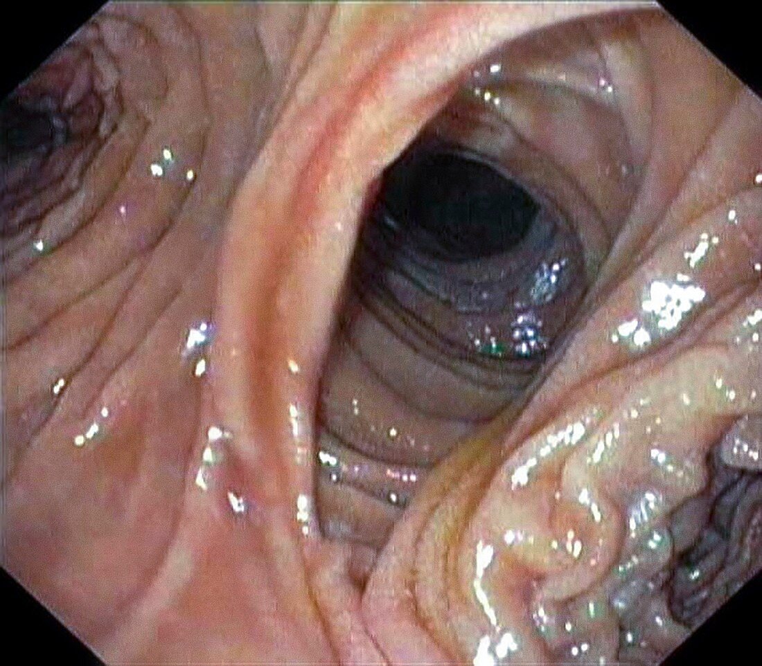 Small intestine anastamosis,endoscopy image