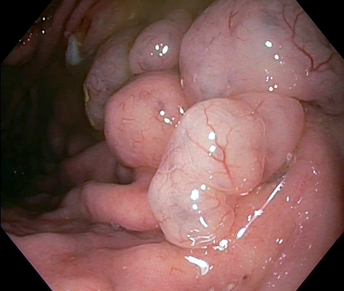 Gastric polyps,endoscopy image