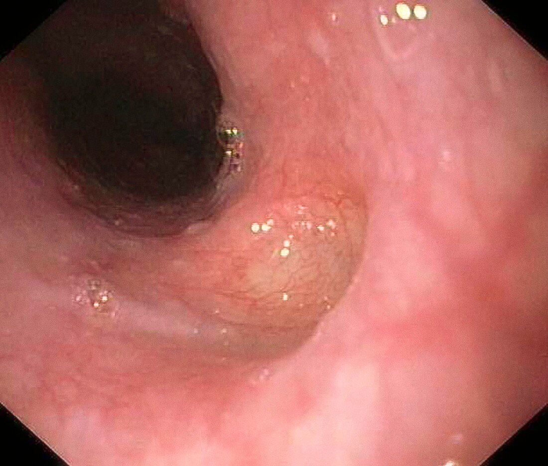 Oesophageal diverticulum,endoscopy image