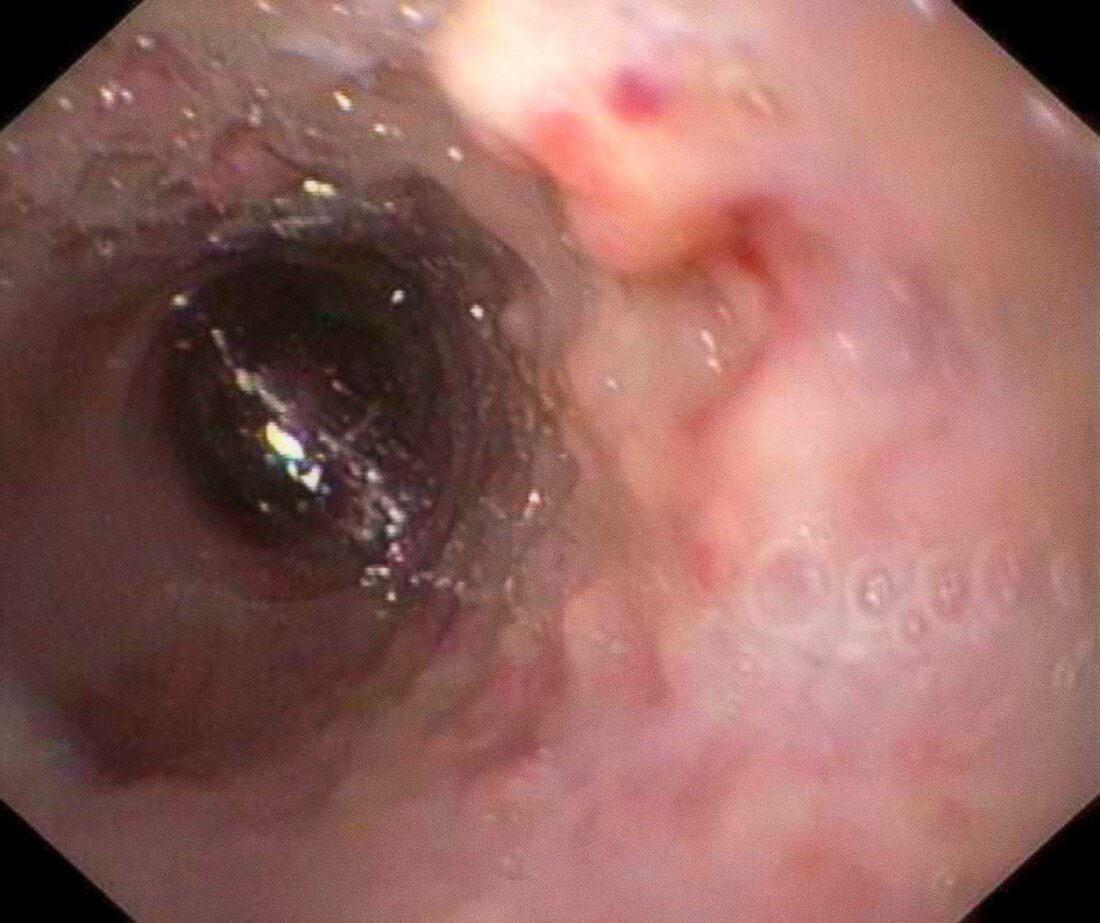 Oesophageal damage,endoscopy image