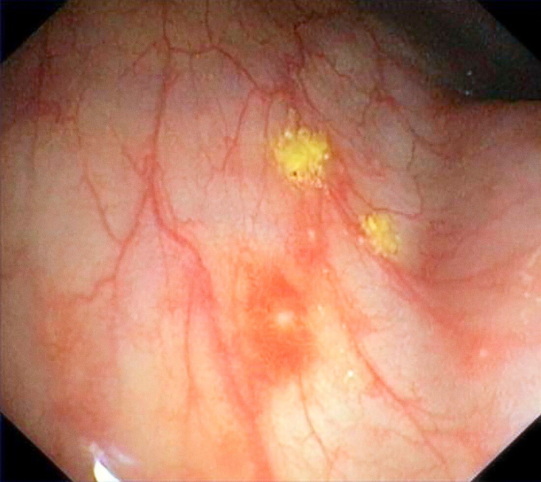 Rectal aphthous ulcers,endoscopy image