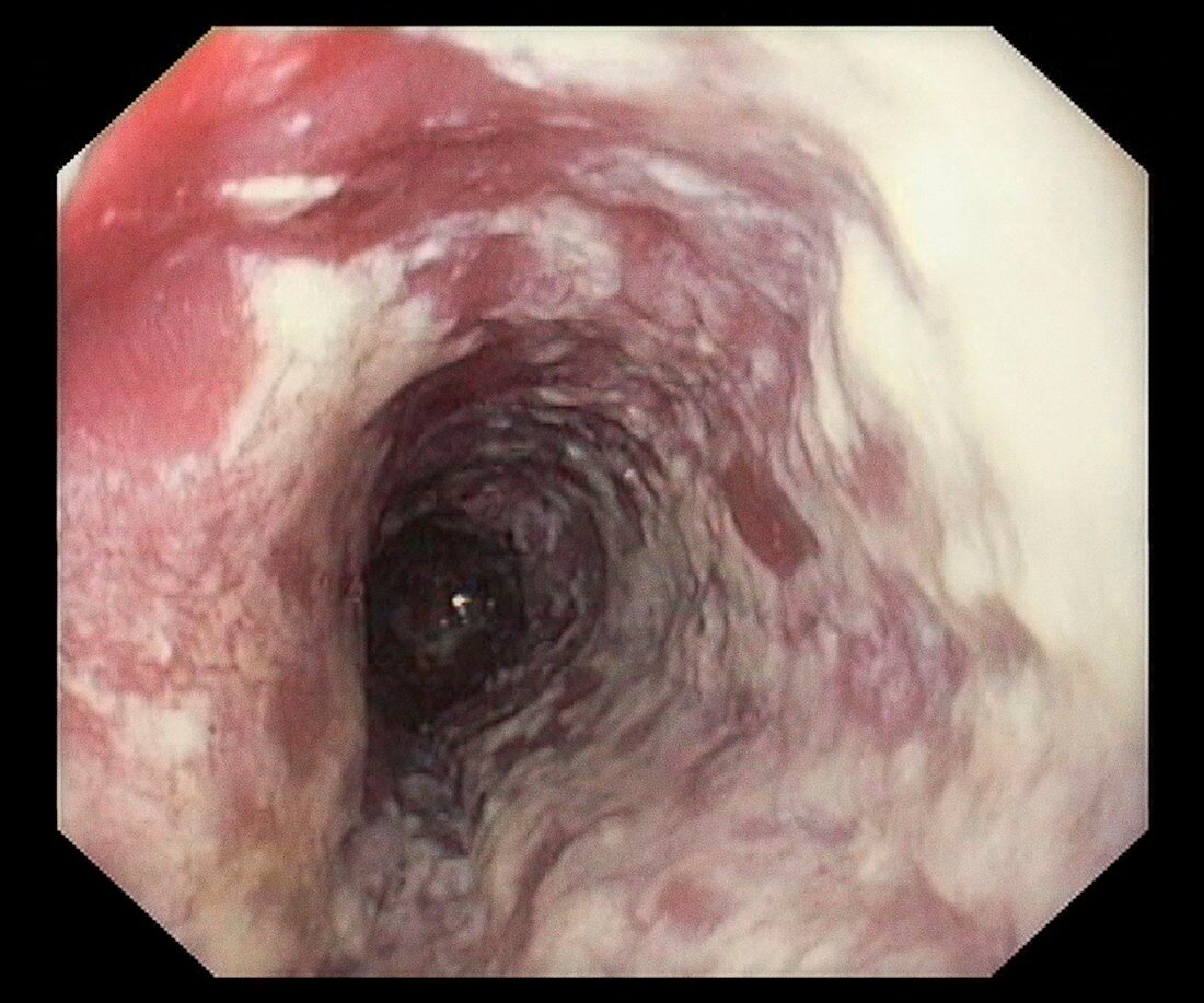 Oesophageal thrush,endoscopy image