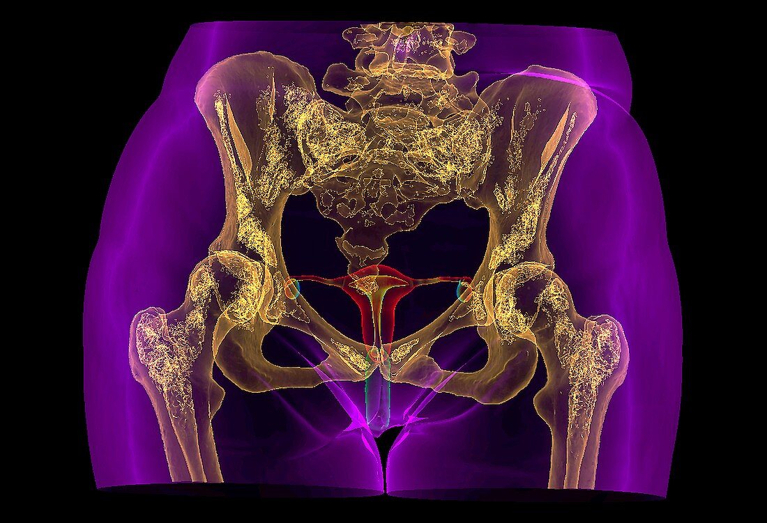 Female reproductive organs and pelvic bones,CT-based image