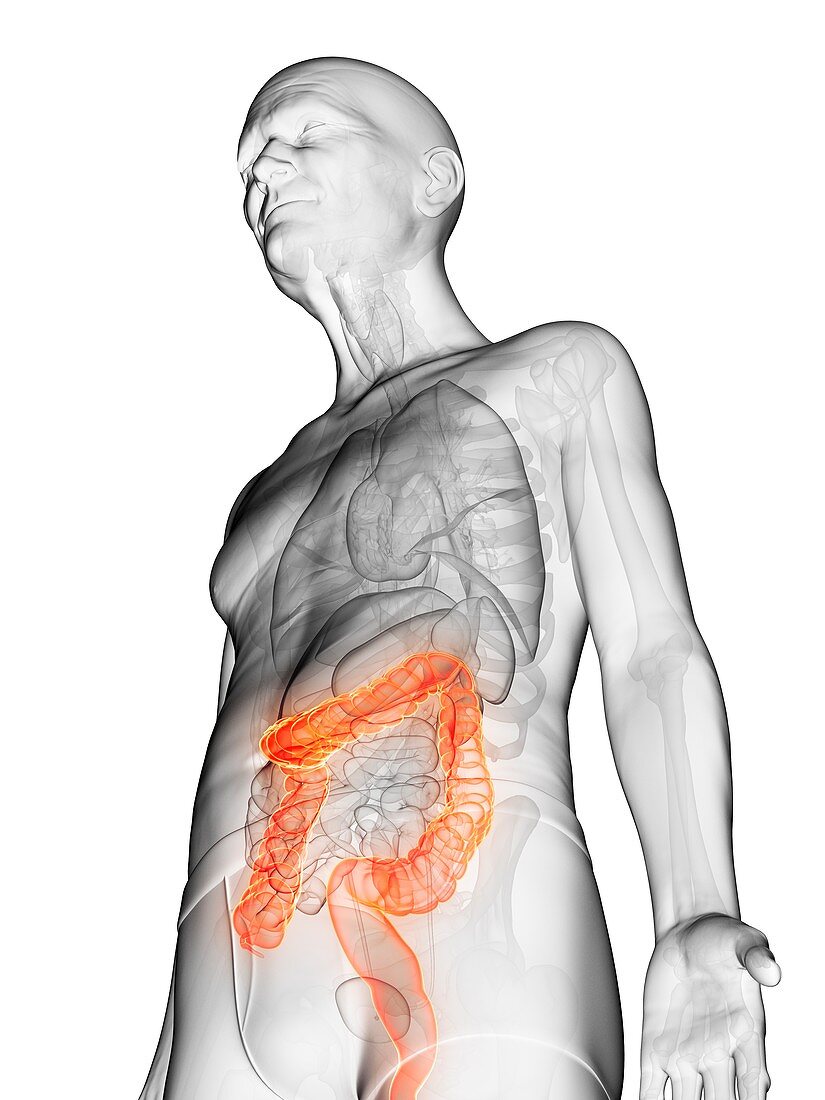 Illustration of an elderly man's colon