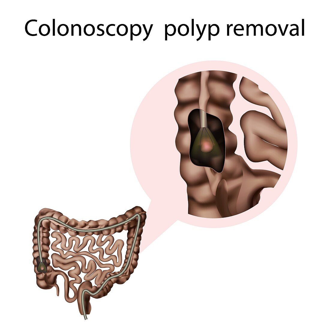 Colonoscopy polyp removal,illustration
