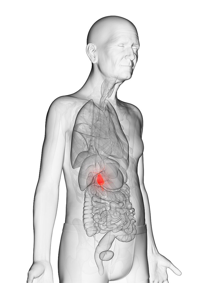 Illustration of an elderly man's gallbladder