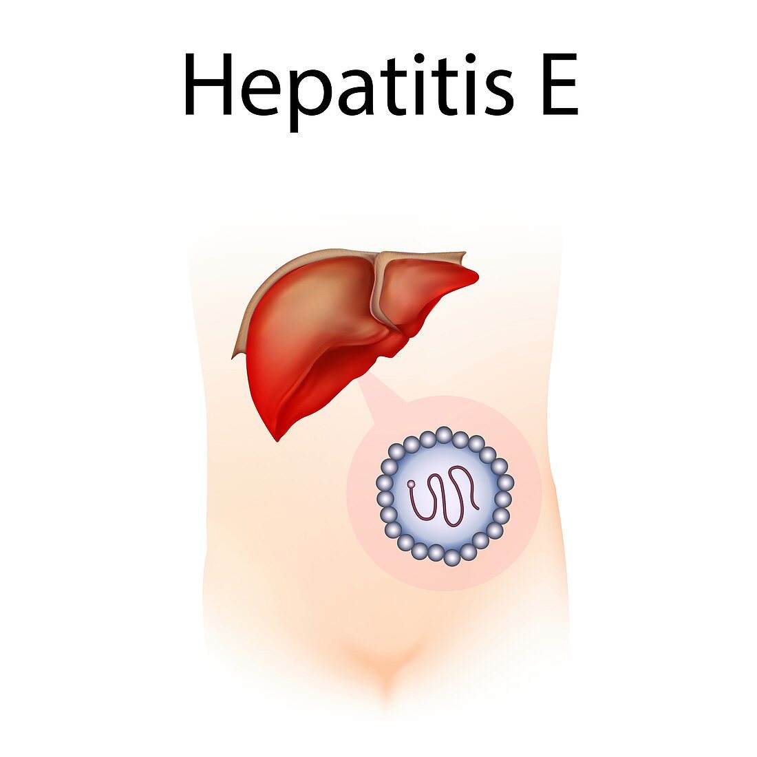 Hepatitis E,illustration