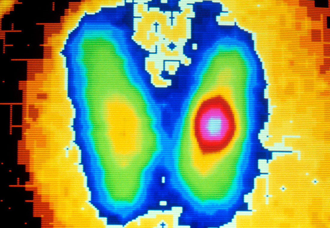 Coloured gamma scan of benign thyroid adenoma
