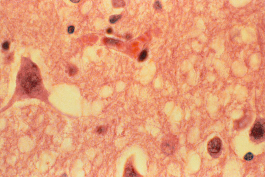 LM of human brain with Creutzfeldt-Jakob disease