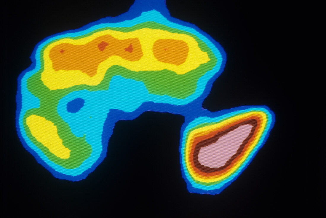 Liver cancer,scintigram