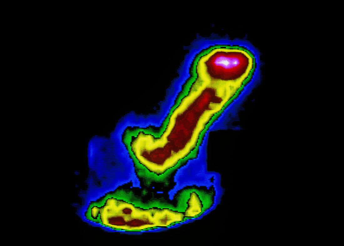 Stomach emptying in dyspepsia: 1hr30m,gamma scan