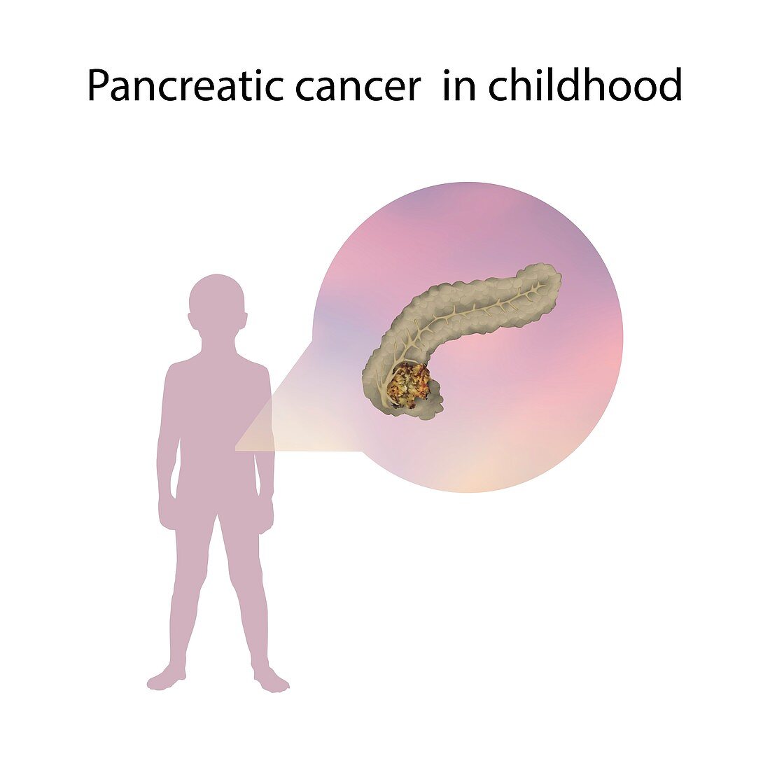Pancreatic cancer in childhood,illustration