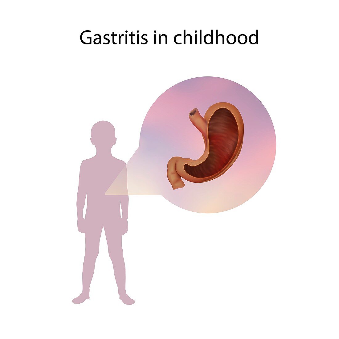 Gastritis in childhood,illustration