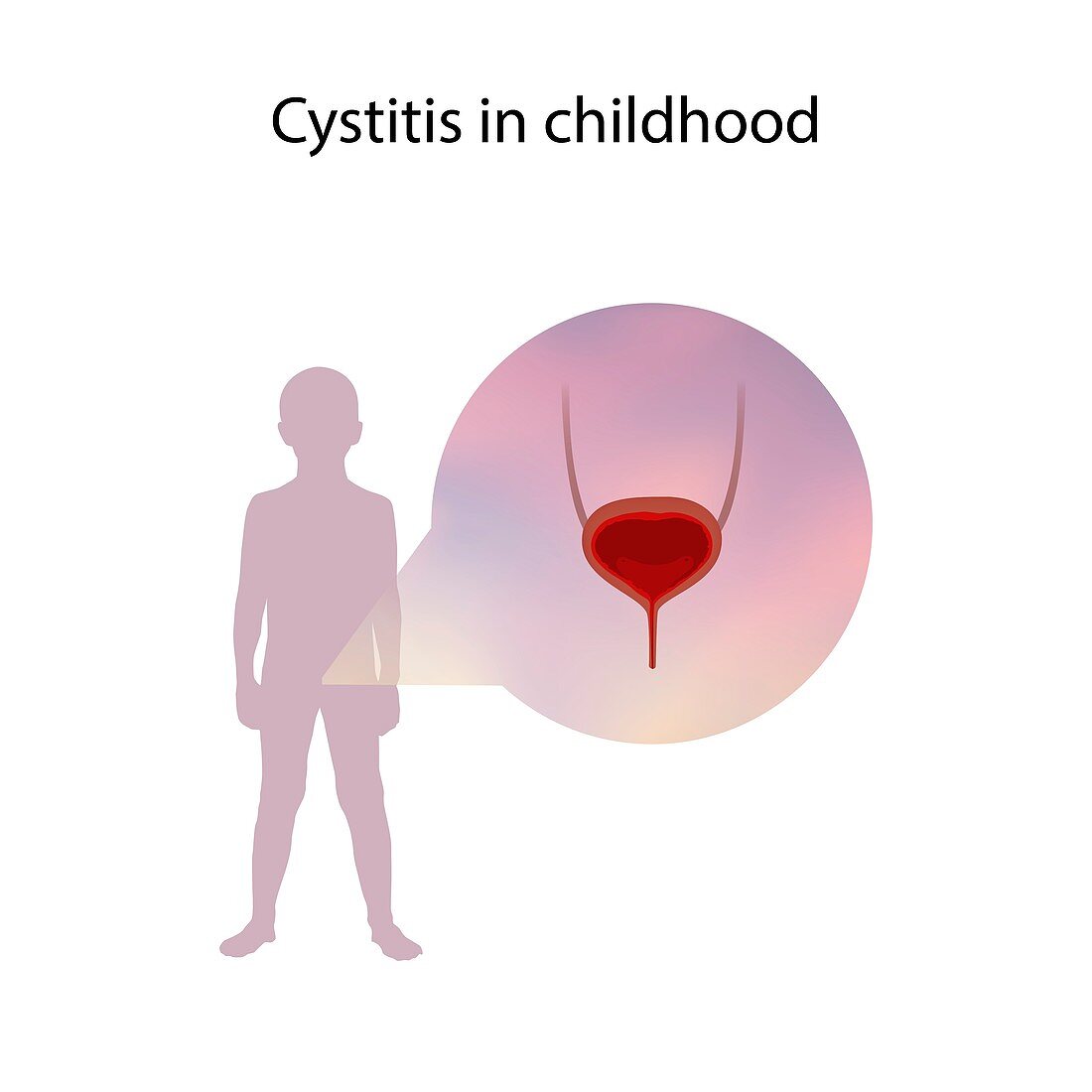 Cystitis in childhood,illustration