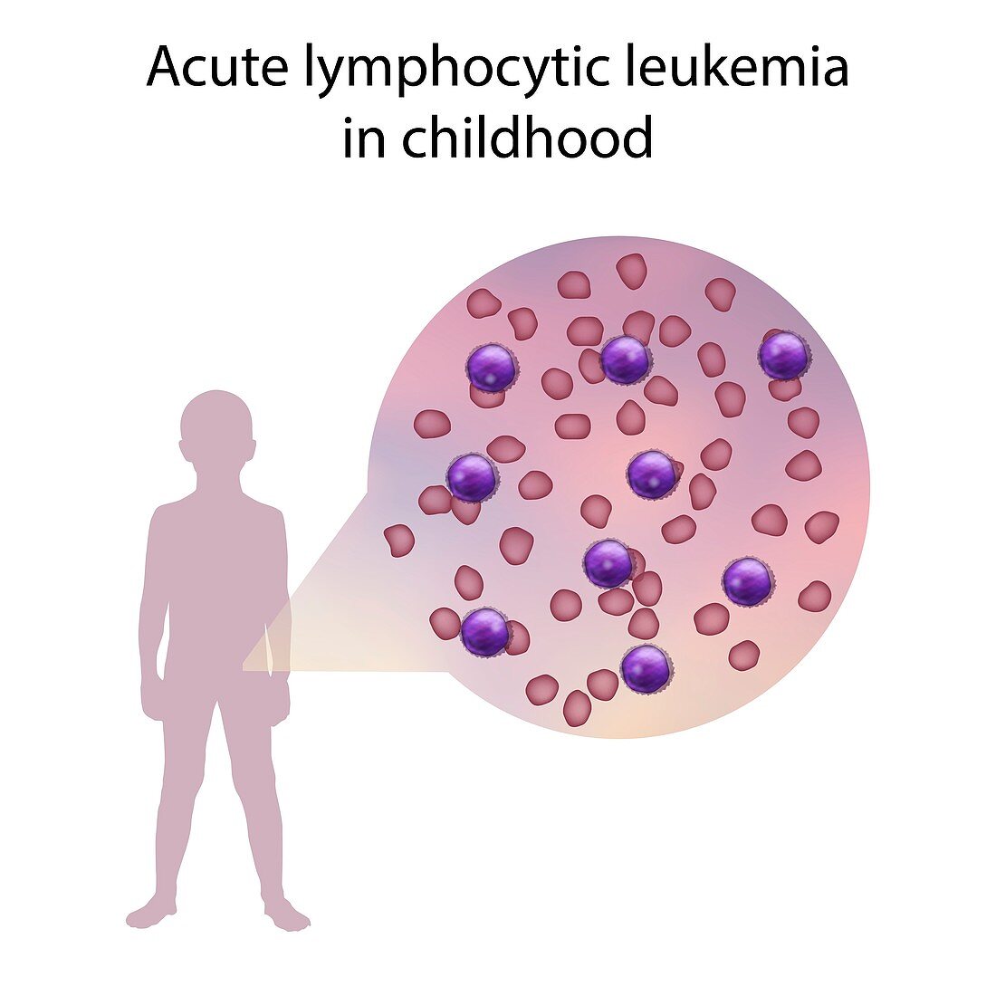Acute lymphocytic leukaemia in childhood,illustration