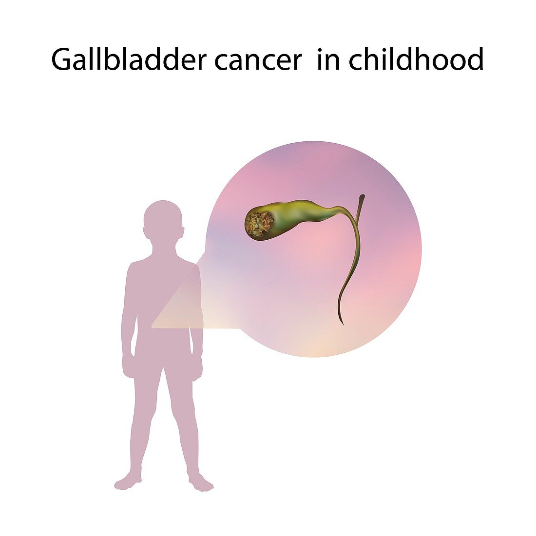 Gallbladder cancer in childhood,illustration