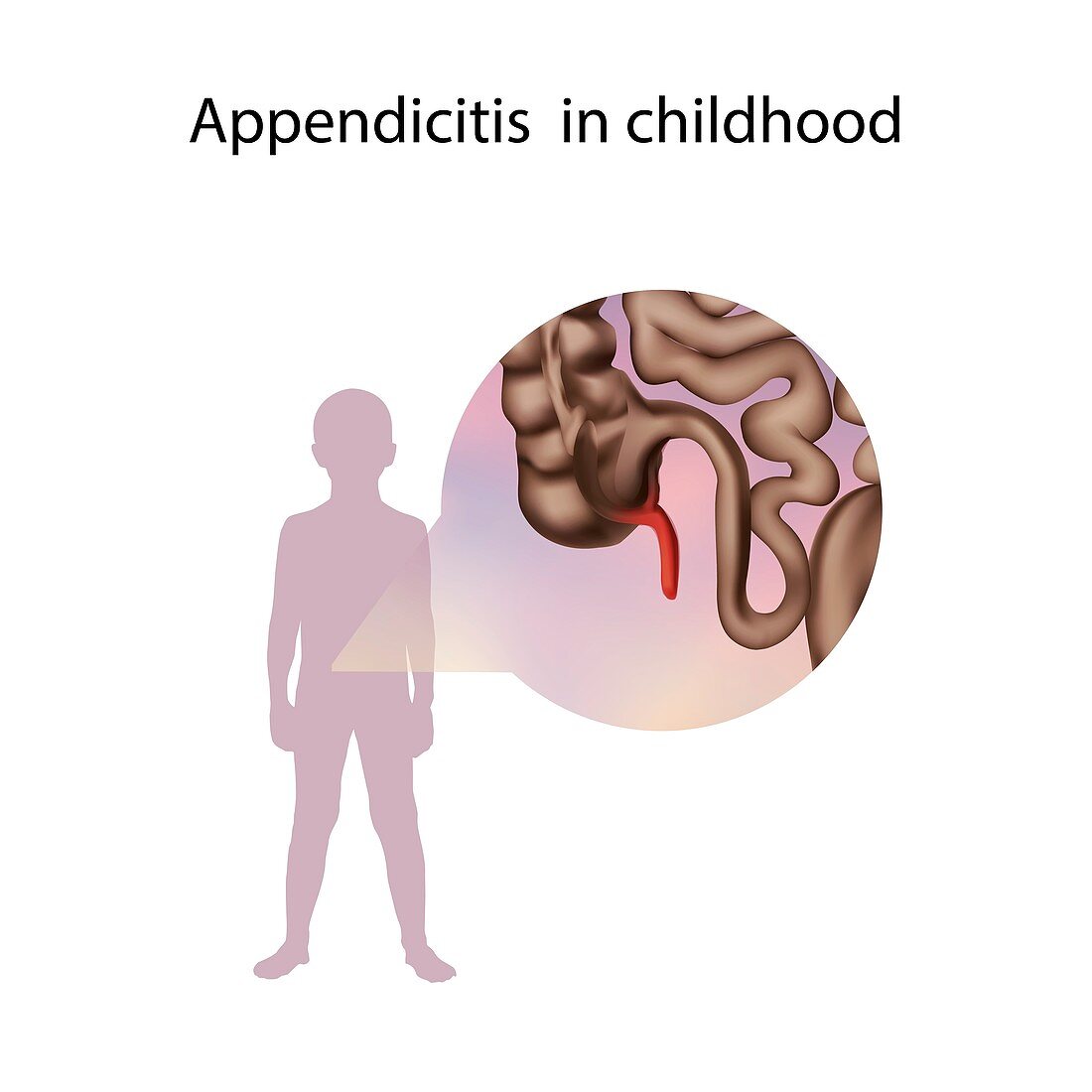 Appendicitis in childhood,illustration