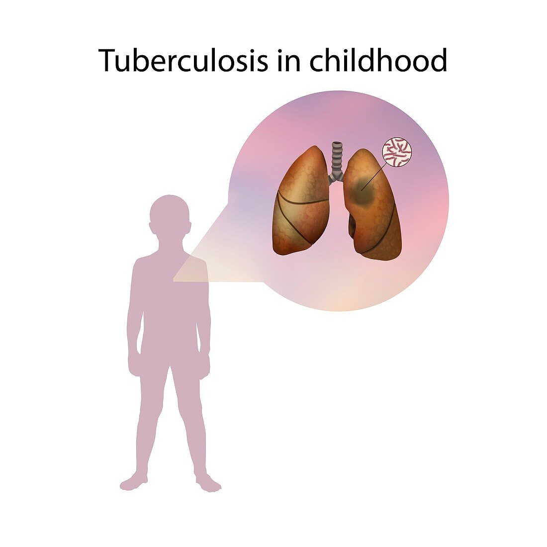 Tuberculosis in childhood,illustration