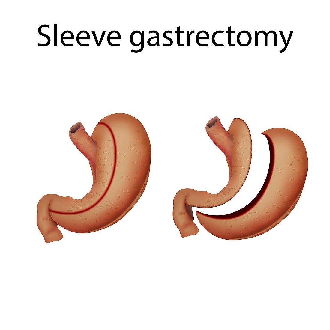 Sleeve gastrectomy,illustration
