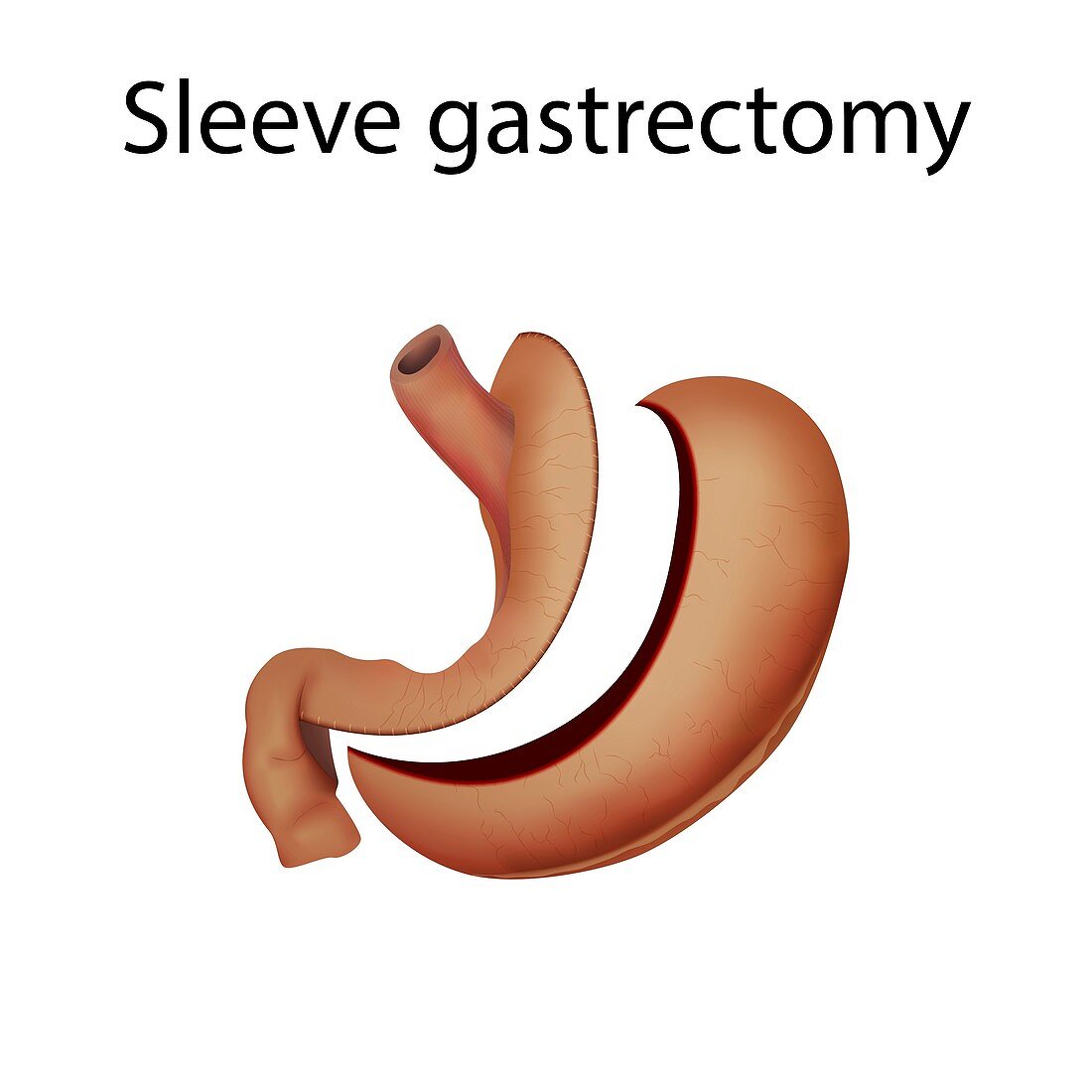 Sleeve gastrectomy,illustration