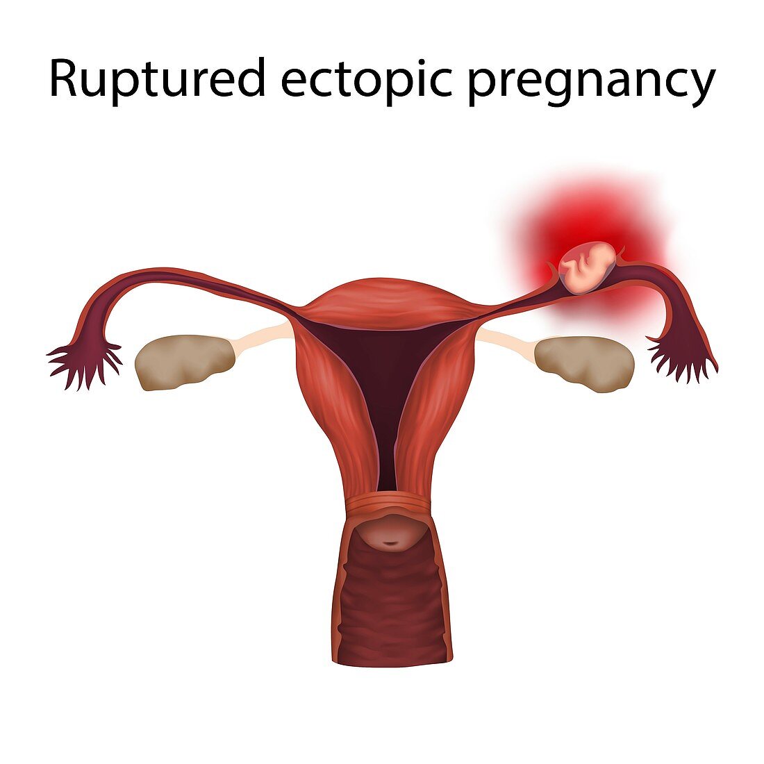 Ruptured ectopic pregnancy,illustration