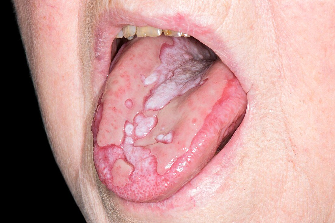 Oral lichen planus