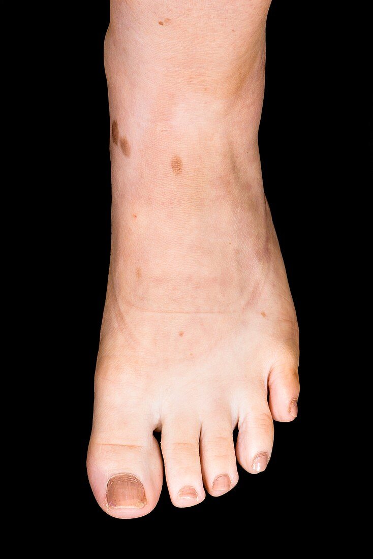 Congenital moles on the foot