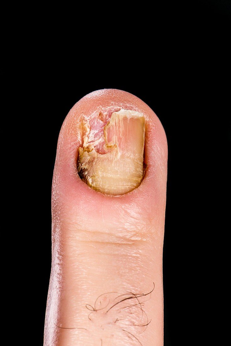 Dystrophic finger nail