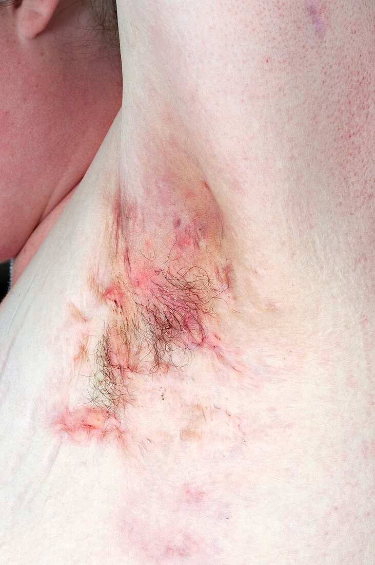 Hidradenitis suppurativa of the armpit