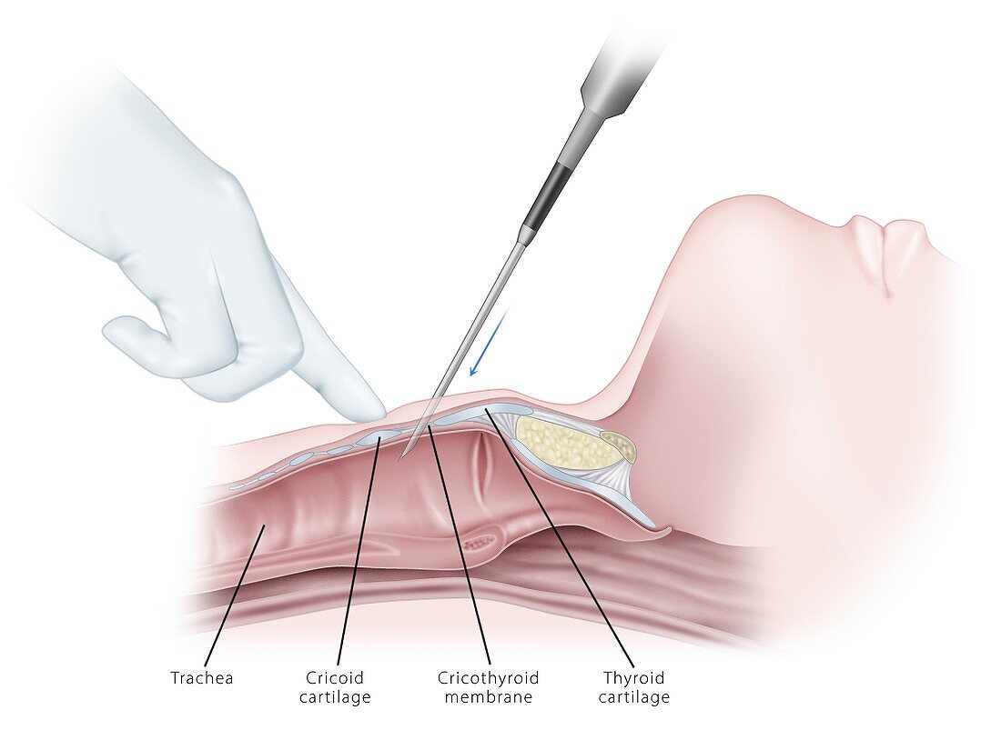 Cricothyrotomy airway puncture, illustration