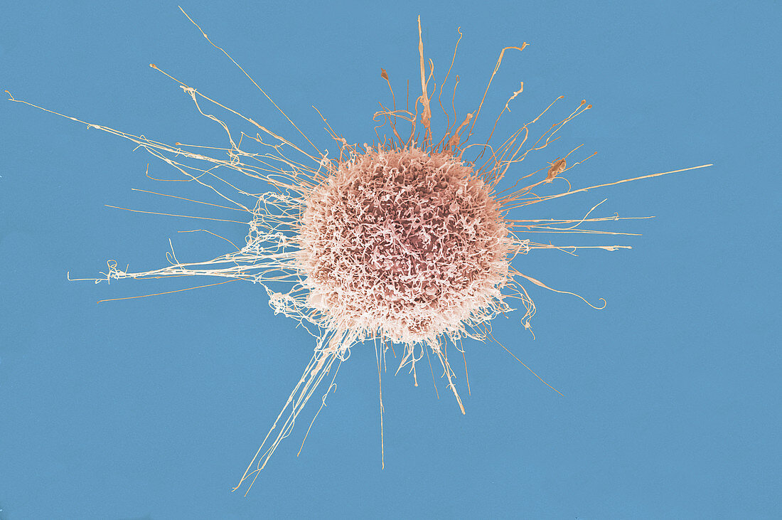 Cervical cancer cell, SEM