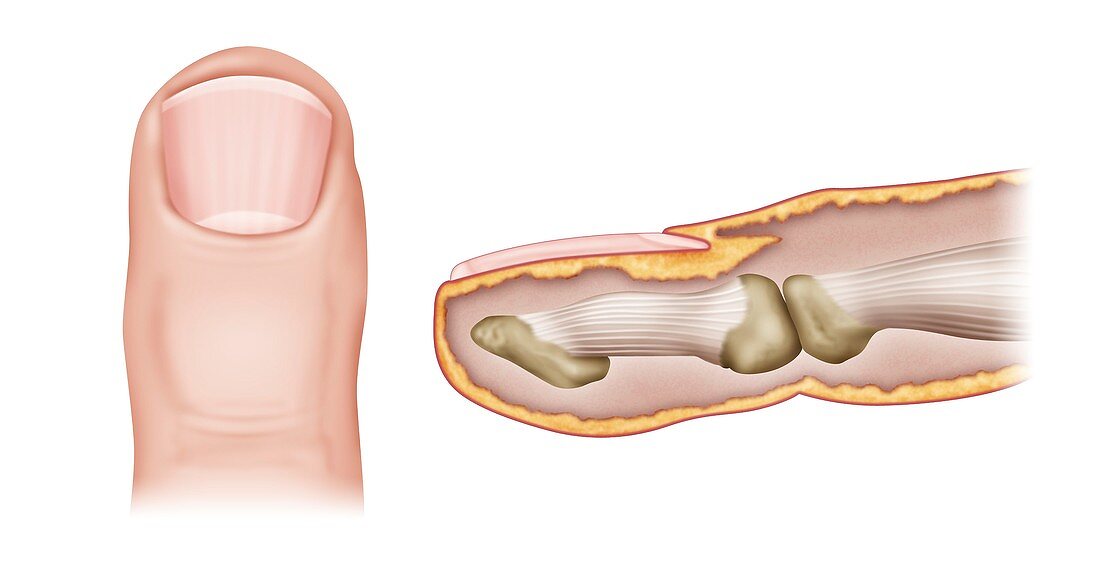 Distal finger joint anatomy, illustration