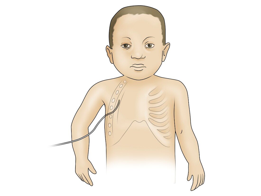 Child with chest drain, illustration