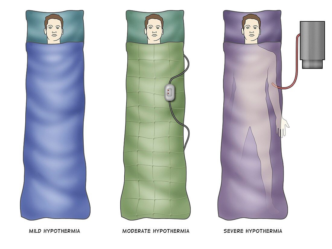 Hypothermia treatments, illustration