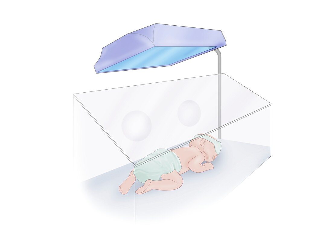 Newborn baby jaundice phototherapy, illustration