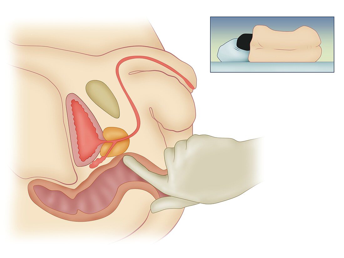 Prostate examination, illustration
