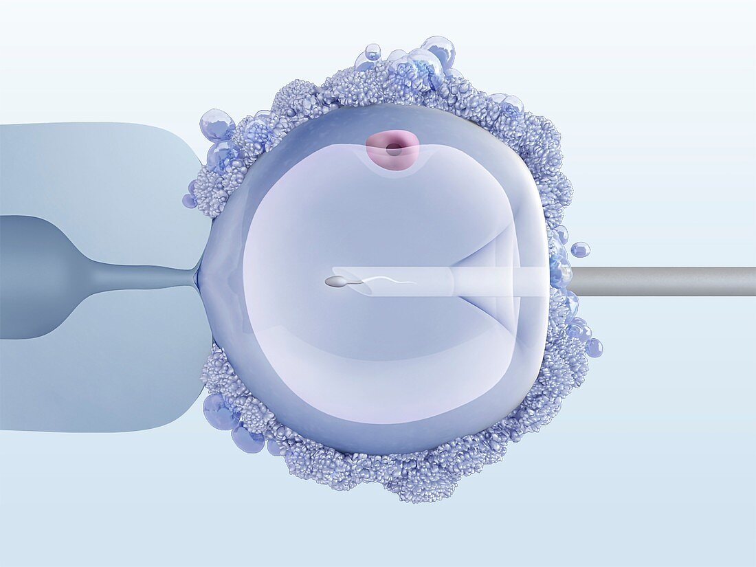 In vitro fertilisation, illustration