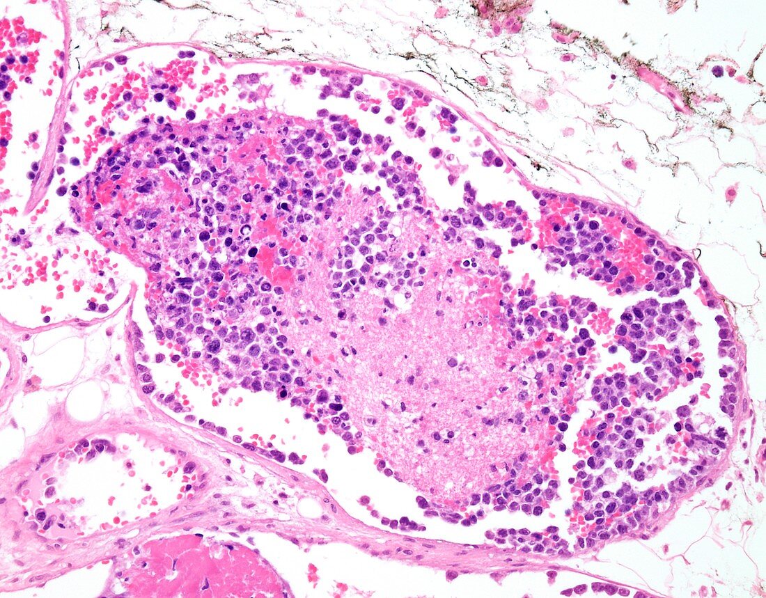 Intravascular large B-cell lymphoma, light micrograph