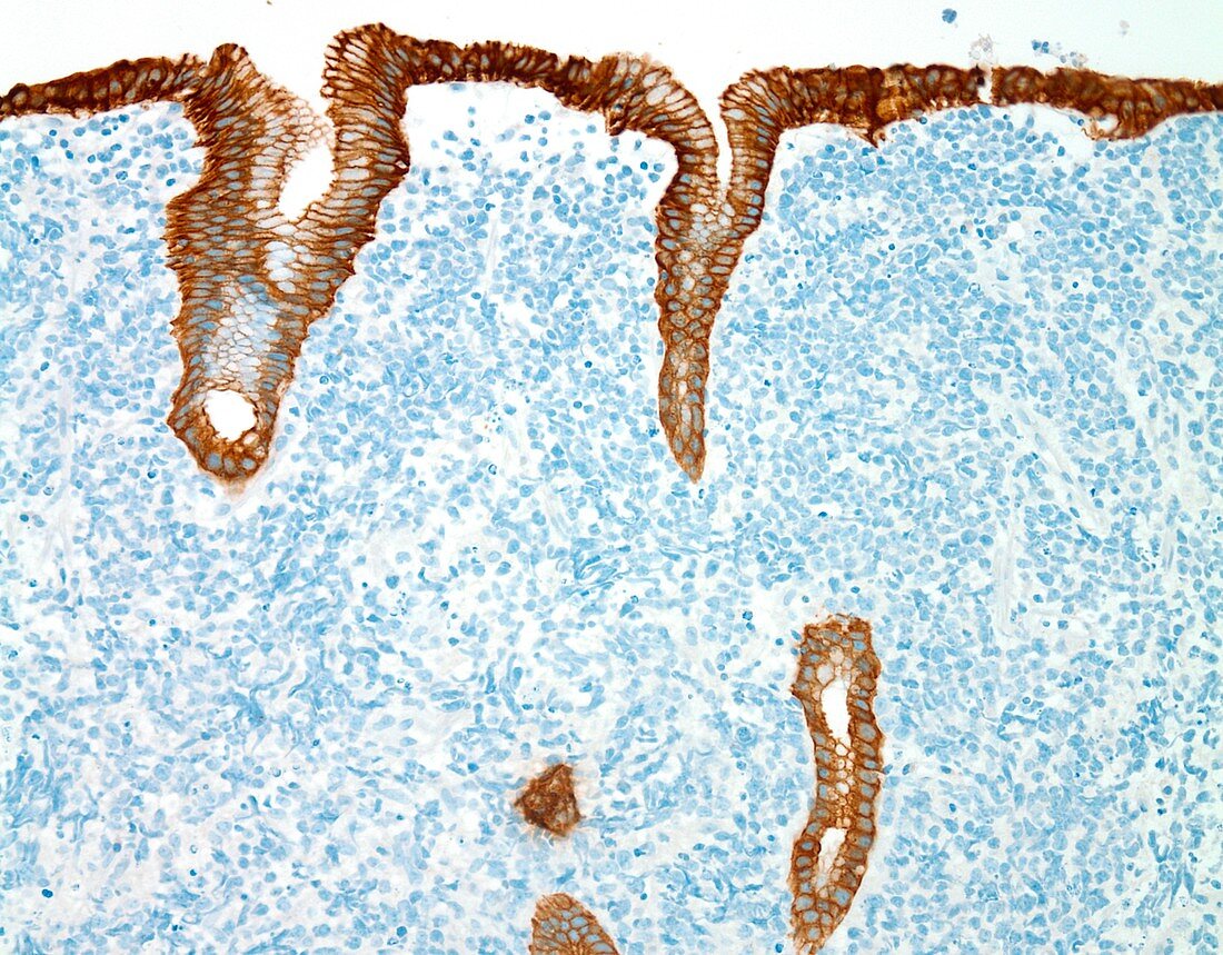 Diffuse large B-cell lymphoma, light micrograph