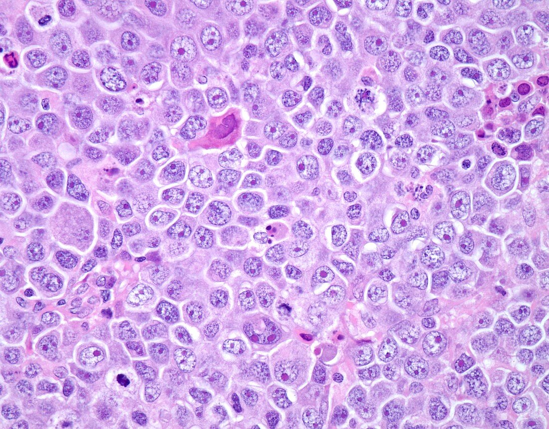 Diffuse large B-cell lymphoma, light micrograph