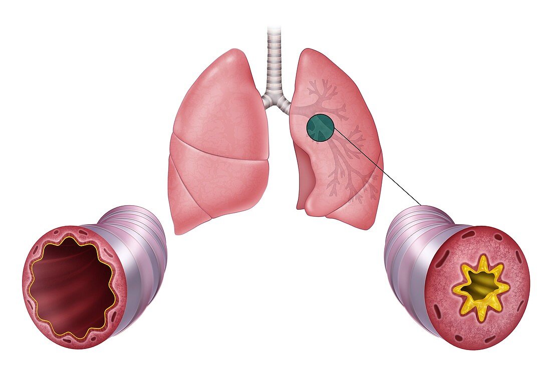 Lung airway inflammation, comparative illustrations