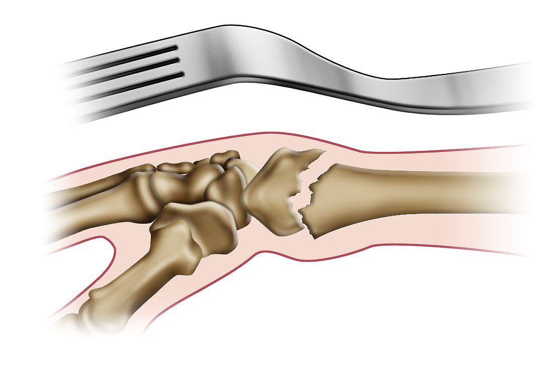 Colles' fracture of the wrist, illustration